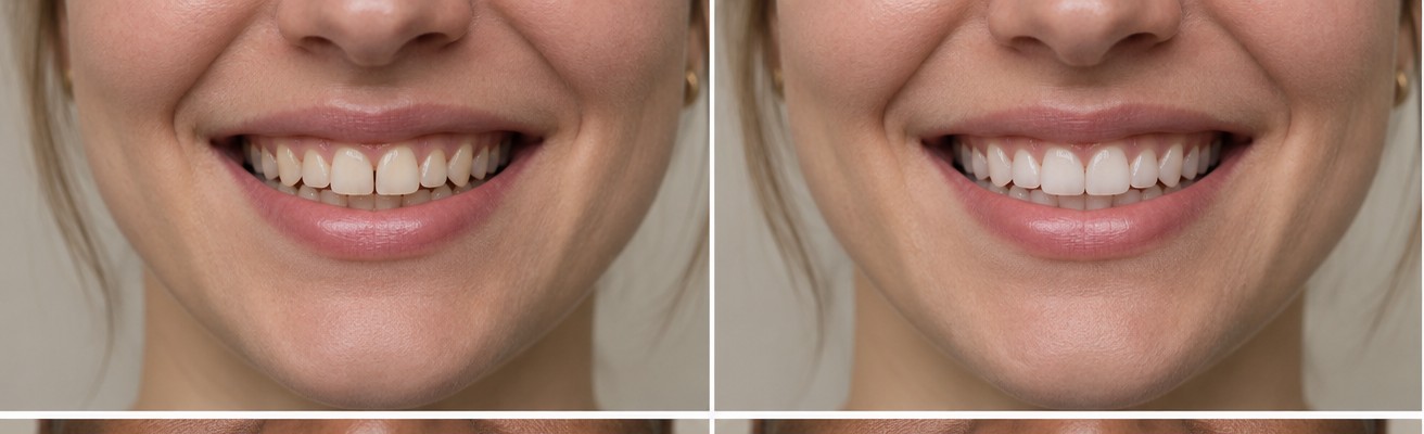  before and after smile case