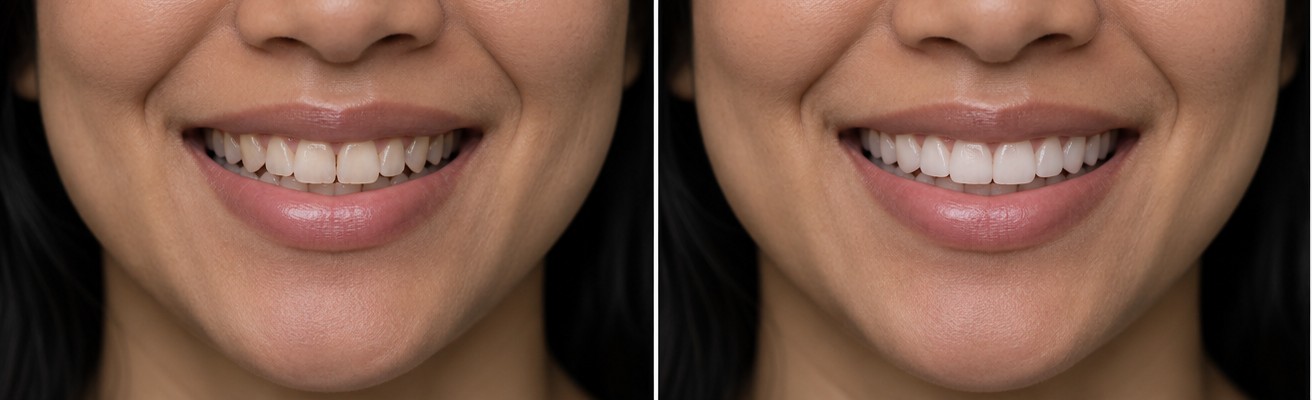  before and after smile case